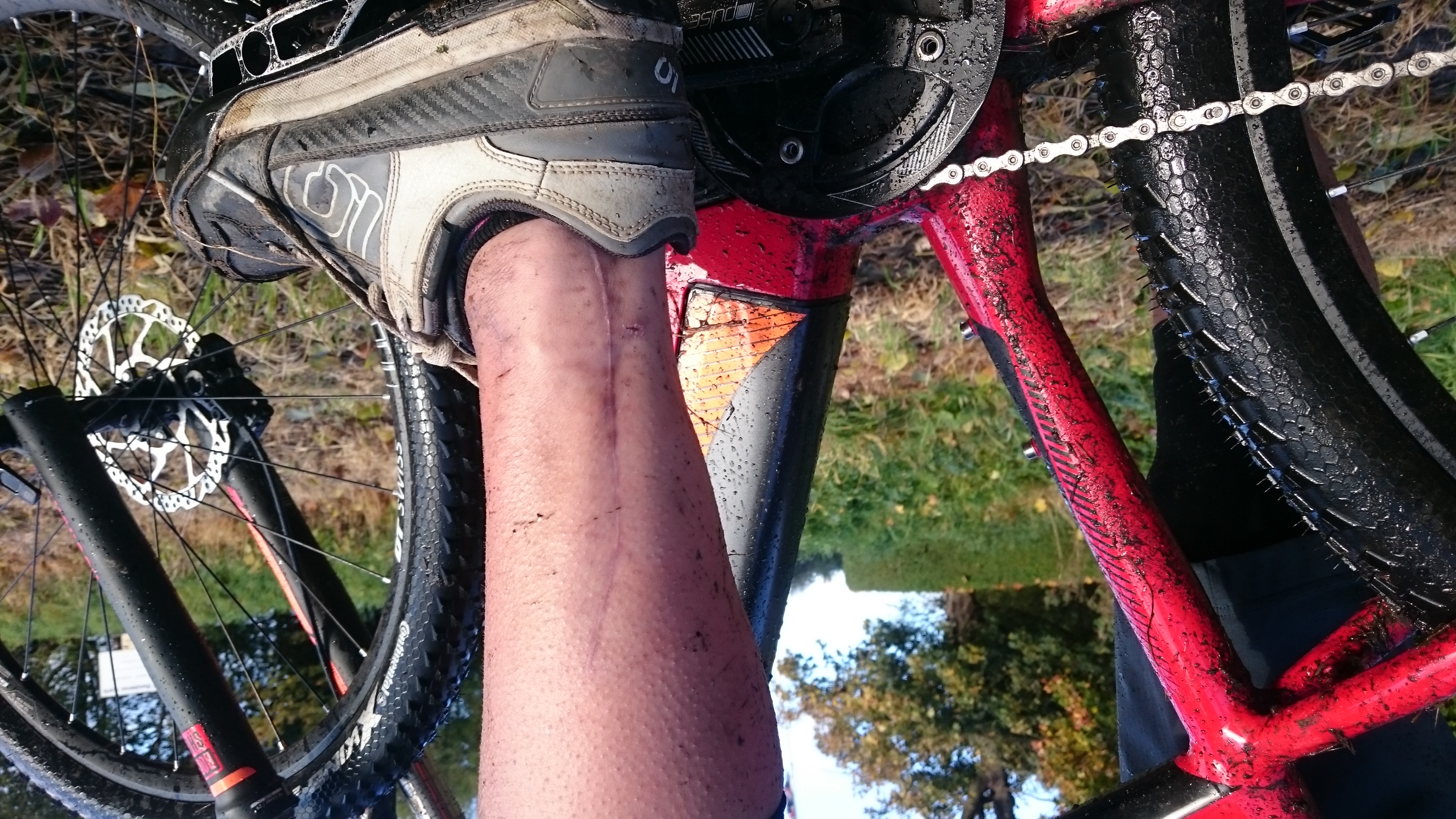 How To Spend A Summer With A Smashed Leg