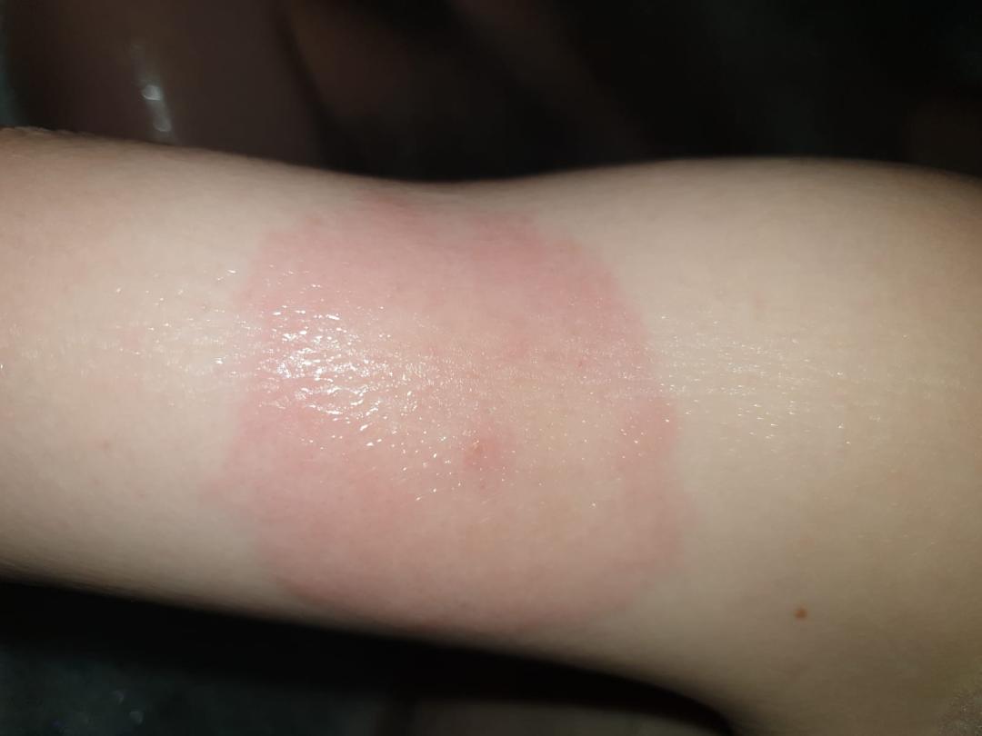 Ticks and Lyme Disease: Advice for Mountain Bikers