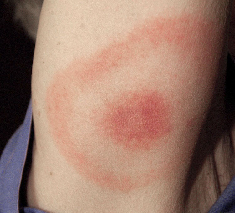 Ticks and Lyme Disease: Advice for Mountain Bikers